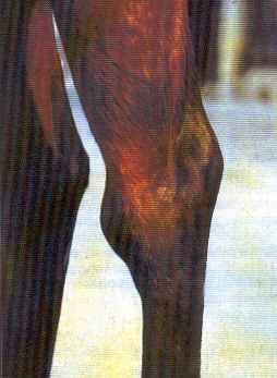 Sinovite no tarso redevet