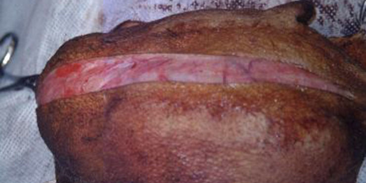 Redevet Hernia ingual2