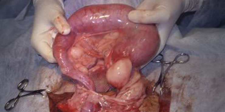 Redevet Hernia ingual4