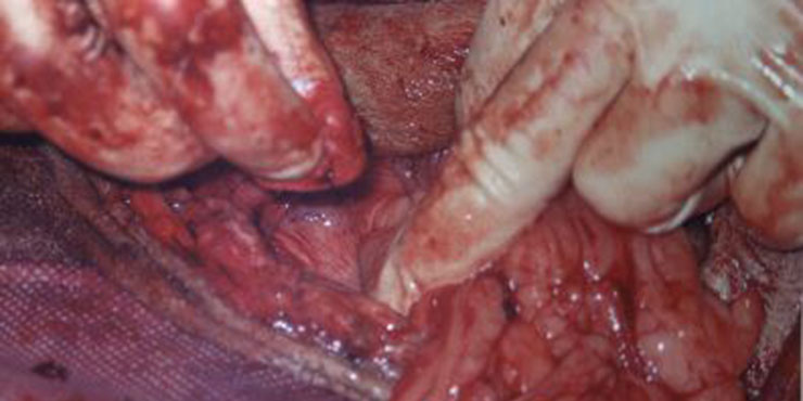 Redevet Hernia ingual6