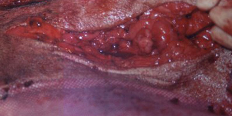 Redevet Hernia ingual9