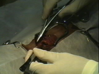 Redevet-Pneumotórax3