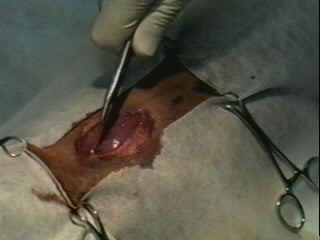 Redevet-Pneumotórax8