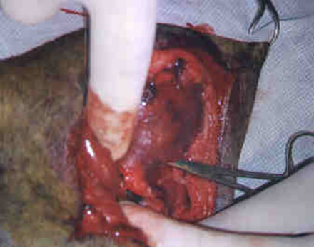 Redevet cirurgia caoxal