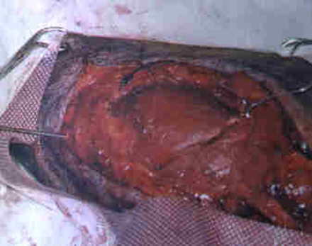 Redevet cirurgia caoxal5