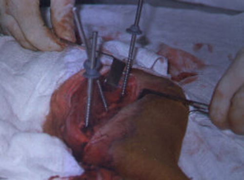 Redevet cirurgia fixação femur