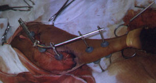 Redevet cirurgia fixação femur2