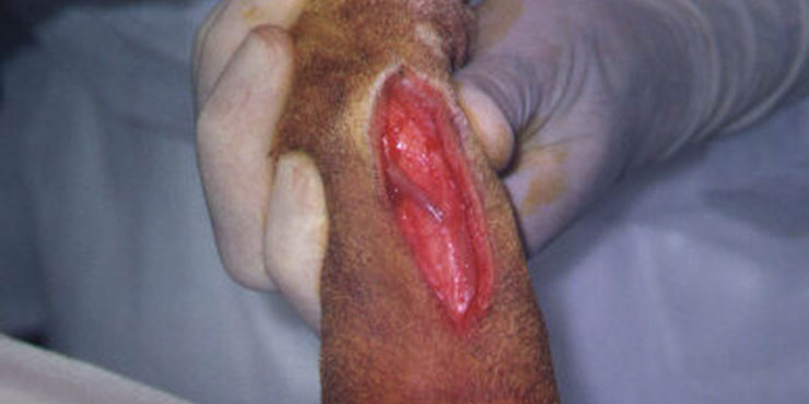 Redevet cirurgia radio ulna externo