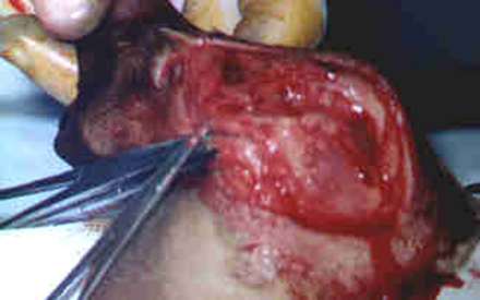 Redevet cirurgia tibia