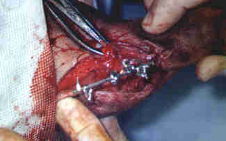 Redevet cirurgia tibia2