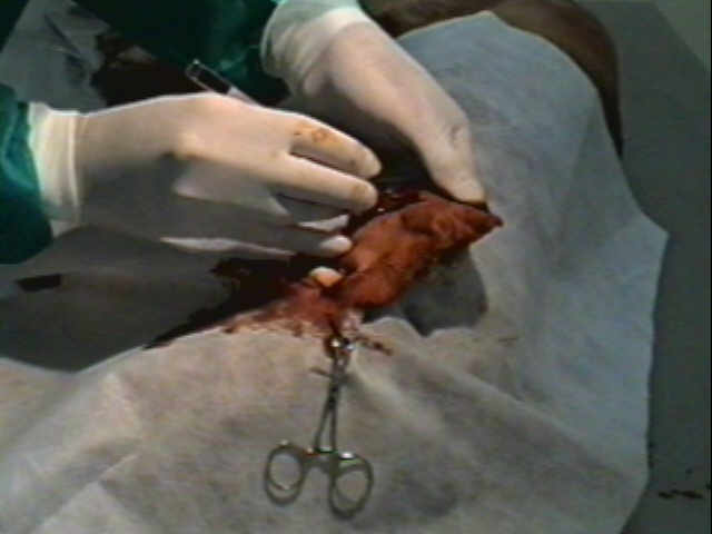 Redevet otohematoma1