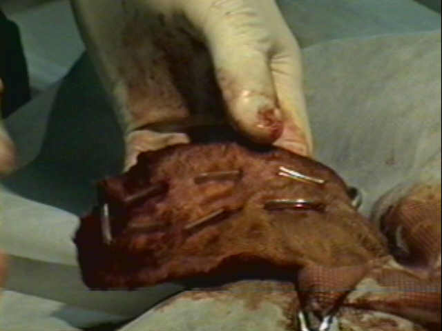 Redevet-otohematoma13