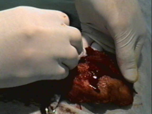 Redevet otohematoma2