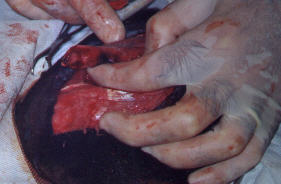 Redevet pino intromedular femur2