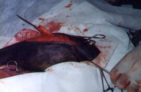 Redevet-pino-intromedular-femur4