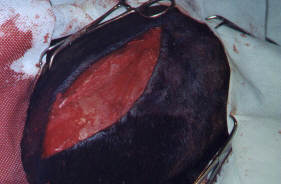 Redevet-pino-intromedular-femur7