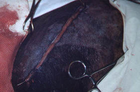 Redevet-pino-intromedular-femur8