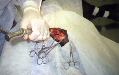 Redevet-resseccao-cabeca-femur3