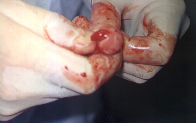 Redevet-resseccao-cabeca-femur5